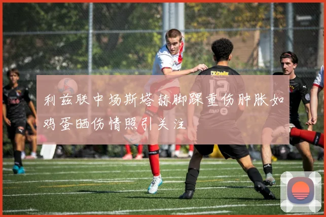 利兹联中场斯塔赫脚踝重伤肿胀如鸡蛋晒伤情照引关注